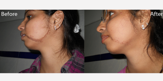 epidermal-naevus