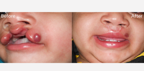 haemangioma