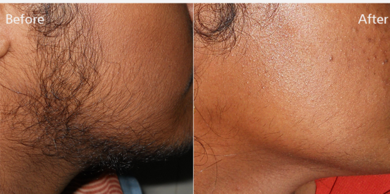 hair-removal