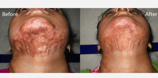 hyper-pigmentation-1