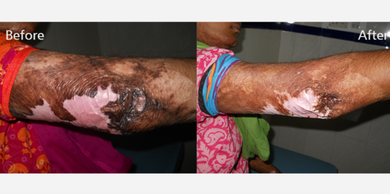hyper-pigmentation-2