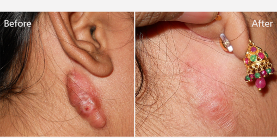 keloid