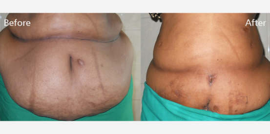 lipo-abdominoplasty