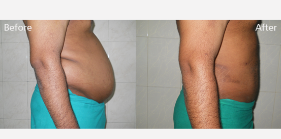 lipo-suction-1