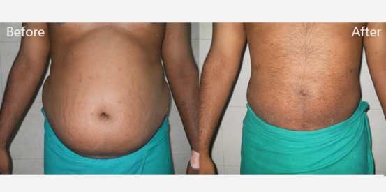 lipo-suction-2