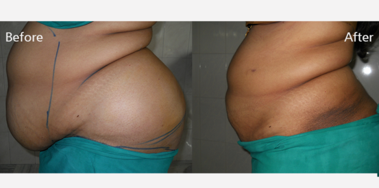 lipo-suction-2