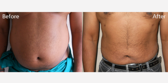 lipo-suction