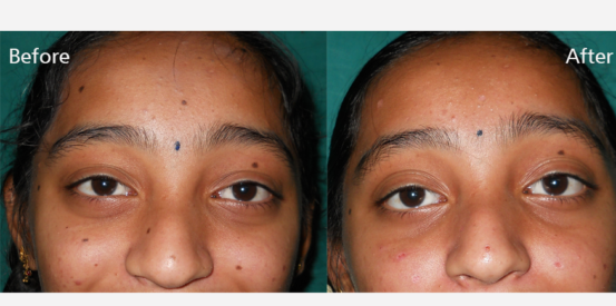 moles