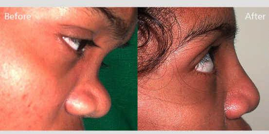 rhinoplasty