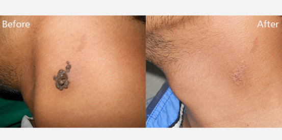 epidermal-naevus2