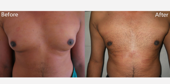 Gynaecomastia