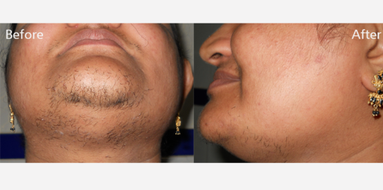 hair-removal-2