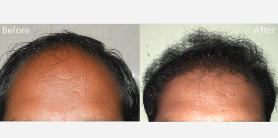 hair-transplantation